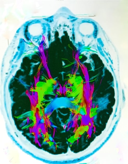 A brain scan image illustrating the changes in brain activity during sleep deprivation. The image should highlight areas related to mood regulation and cognitive function.